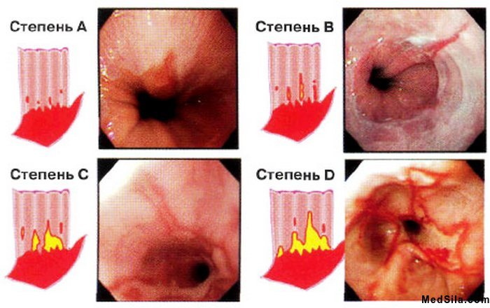 классификация эзофагитов